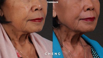 Thermage FLX Before & After Gallery - Patient 368652 - Image 2