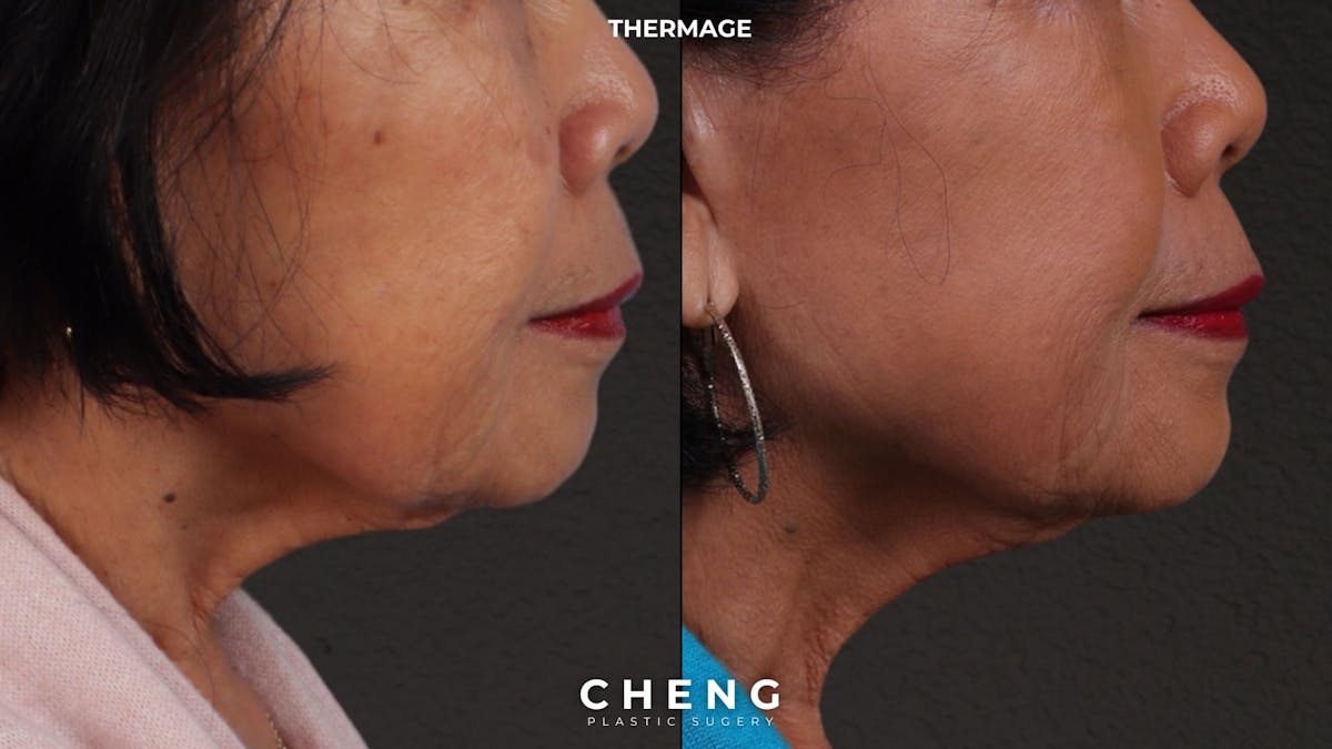 Thermage Flx Before & After Gallery - Patient 368652 - Image 1