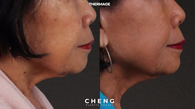 Thermage Flx Before & After Gallery - Patient 368652 - Image 1
