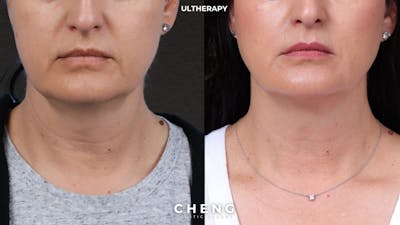 Ultherapy Before & After Gallery - Patient 134958 - Image 1