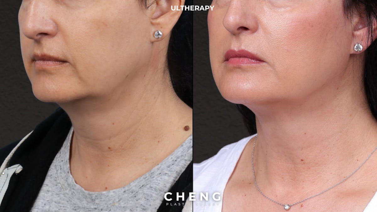 Ultherapy Before & After Gallery - Patient 134958 - Image 2
