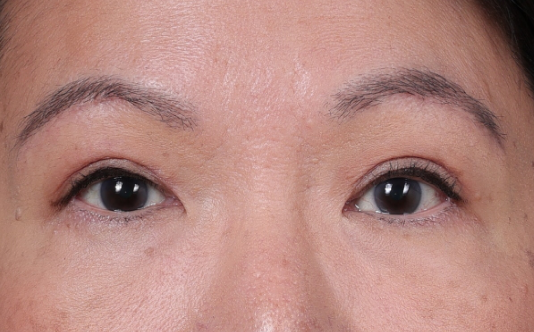 Brow Lift Before & After Gallery - Patient 400205 - Image 2