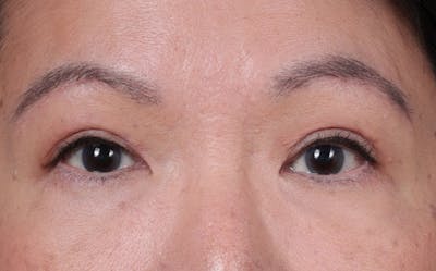 Blepharoplasty Before & After Gallery - Patient 107253 - Image 2