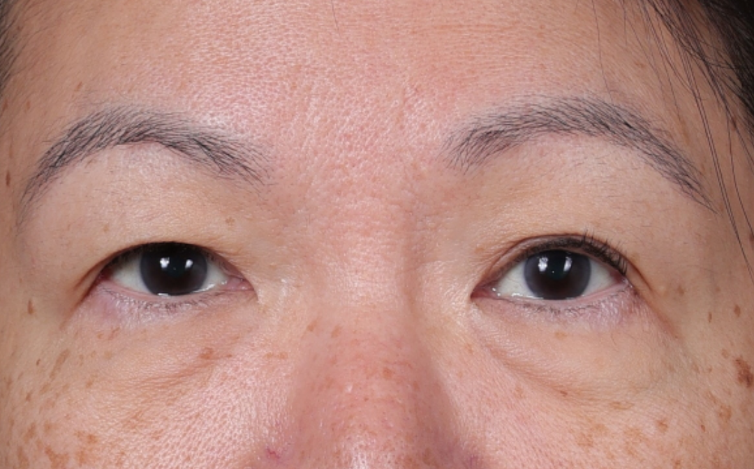Brow Lift Before & After Gallery - Patient 400205 - Image 1