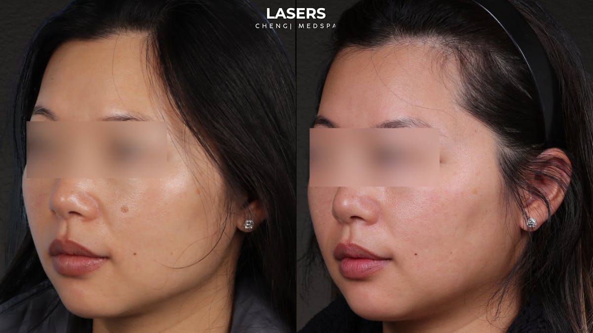 Pigment Laser Before & After Gallery - Patient 356417 - Image 3