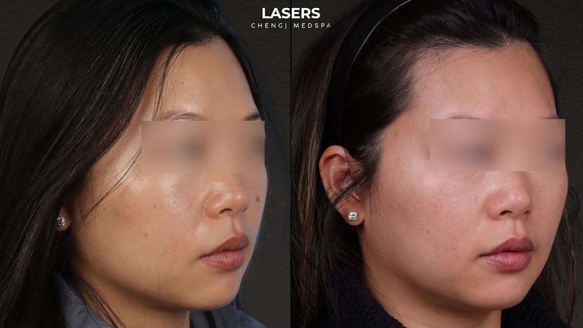 Pigment Laser Before & After Gallery - Patient 356417 - Image 2