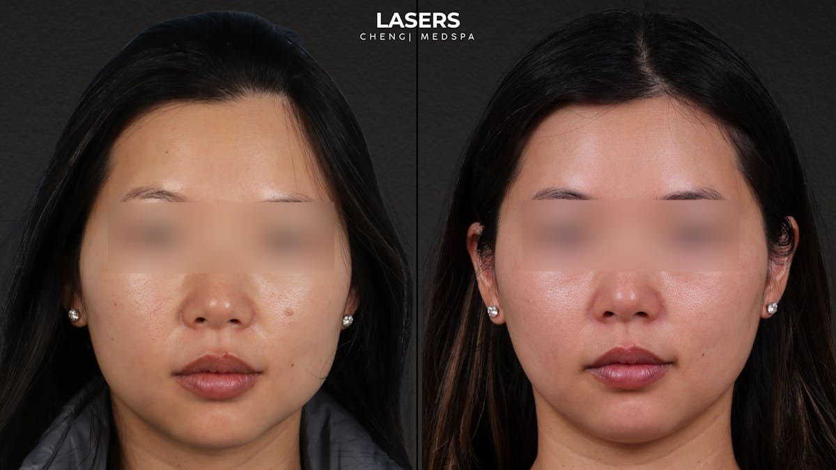 Pigment Laser Before & After Gallery - Patient 356417 - Image 1