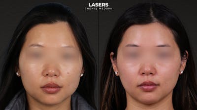 Pigment Laser Before & After Gallery - Patient 356417 - Image 1