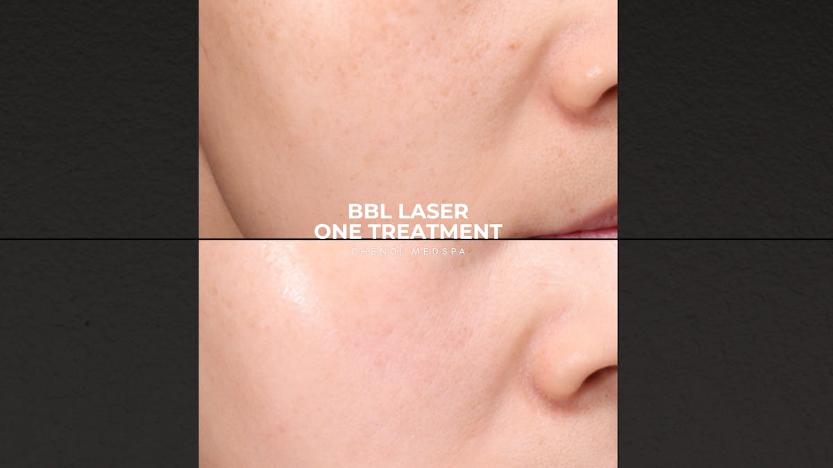 BBL Laser Before & After Gallery - Patient 296578 - Image 1