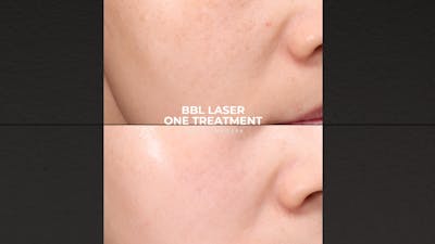 BBL Laser Before & After Gallery - Patient 296578 - Image 1