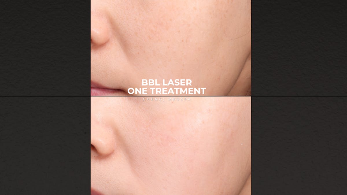 BBL Laser Before & After Gallery - Patient 296578 - Image 2