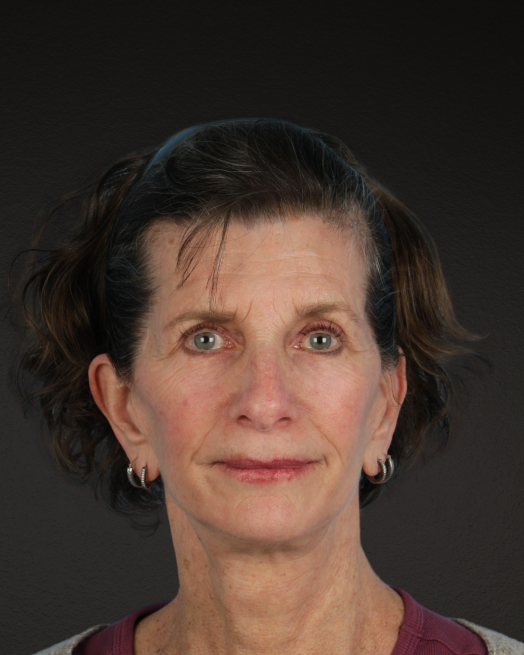 Facelift Before & After Gallery - Patient 307064 - Image 2