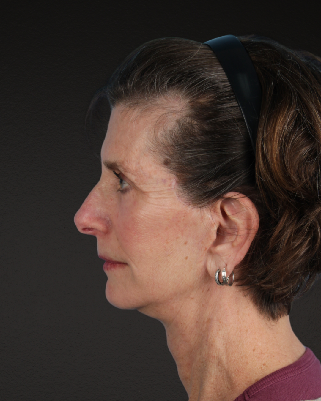 Facelift Before & After Gallery - Patient 307064 - Image 10