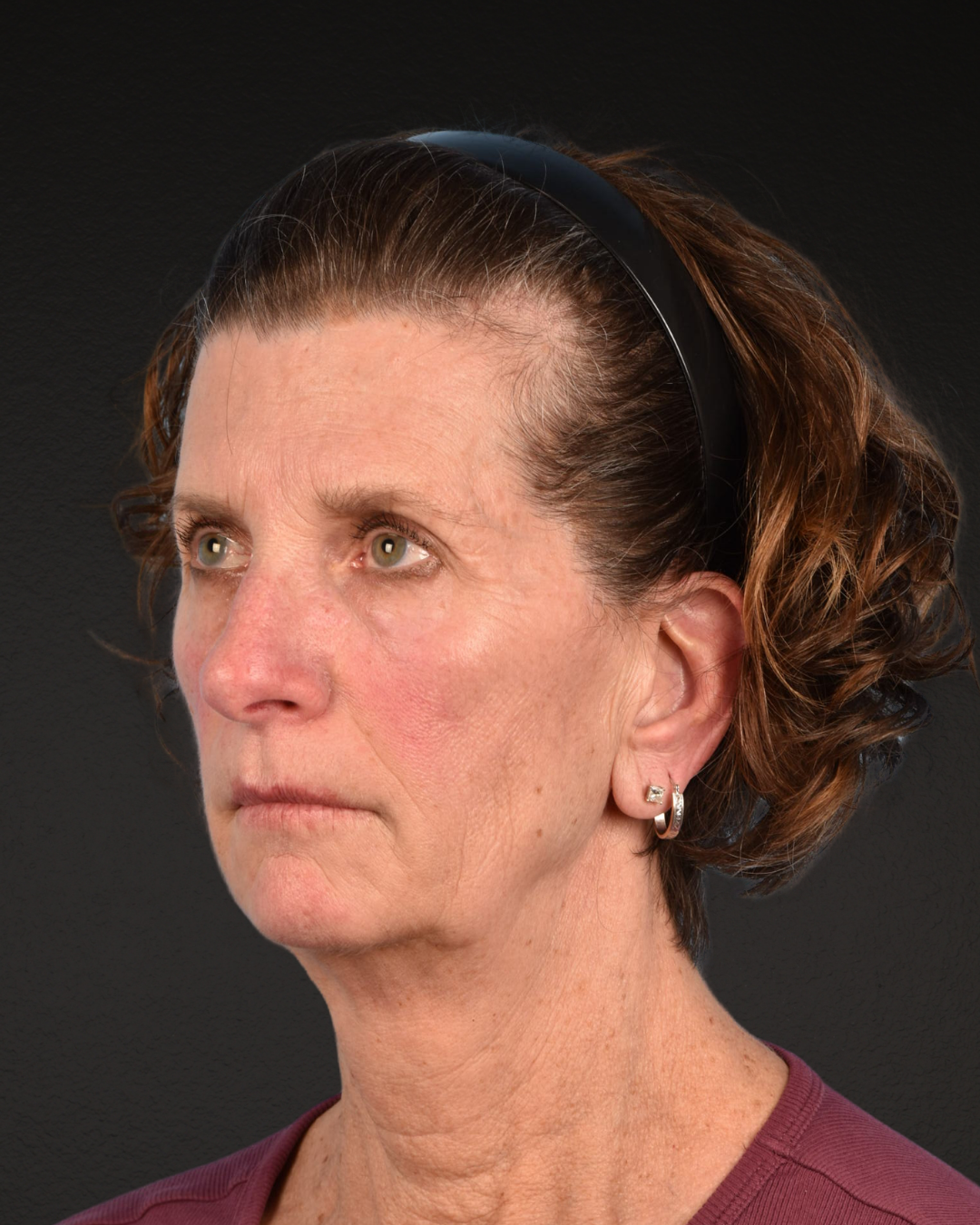 Facelift Before & After Gallery - Patient 307064 - Image 7