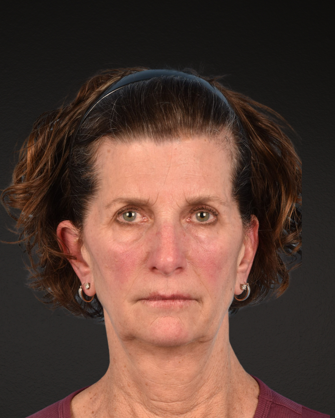 Facelift Before & After Gallery - Patient 307064 - Image 1