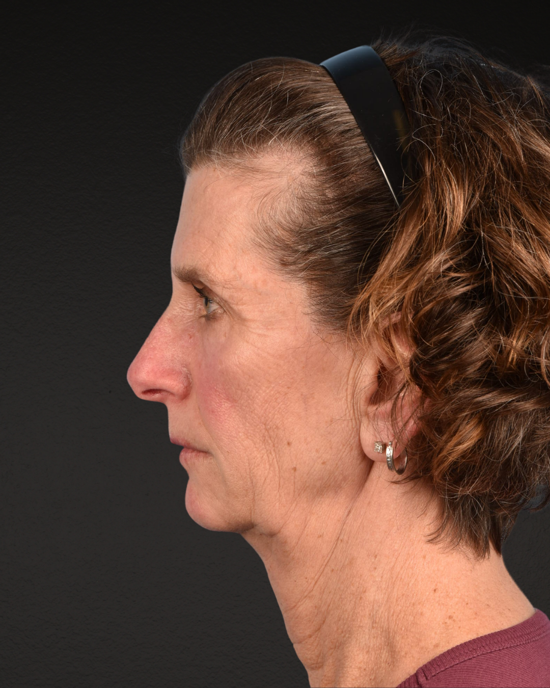 Facelift Before & After Gallery - Patient 307064 - Image 9