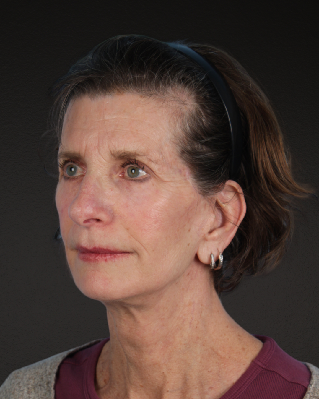 Facelift Before & After Gallery - Patient 307064 - Image 8