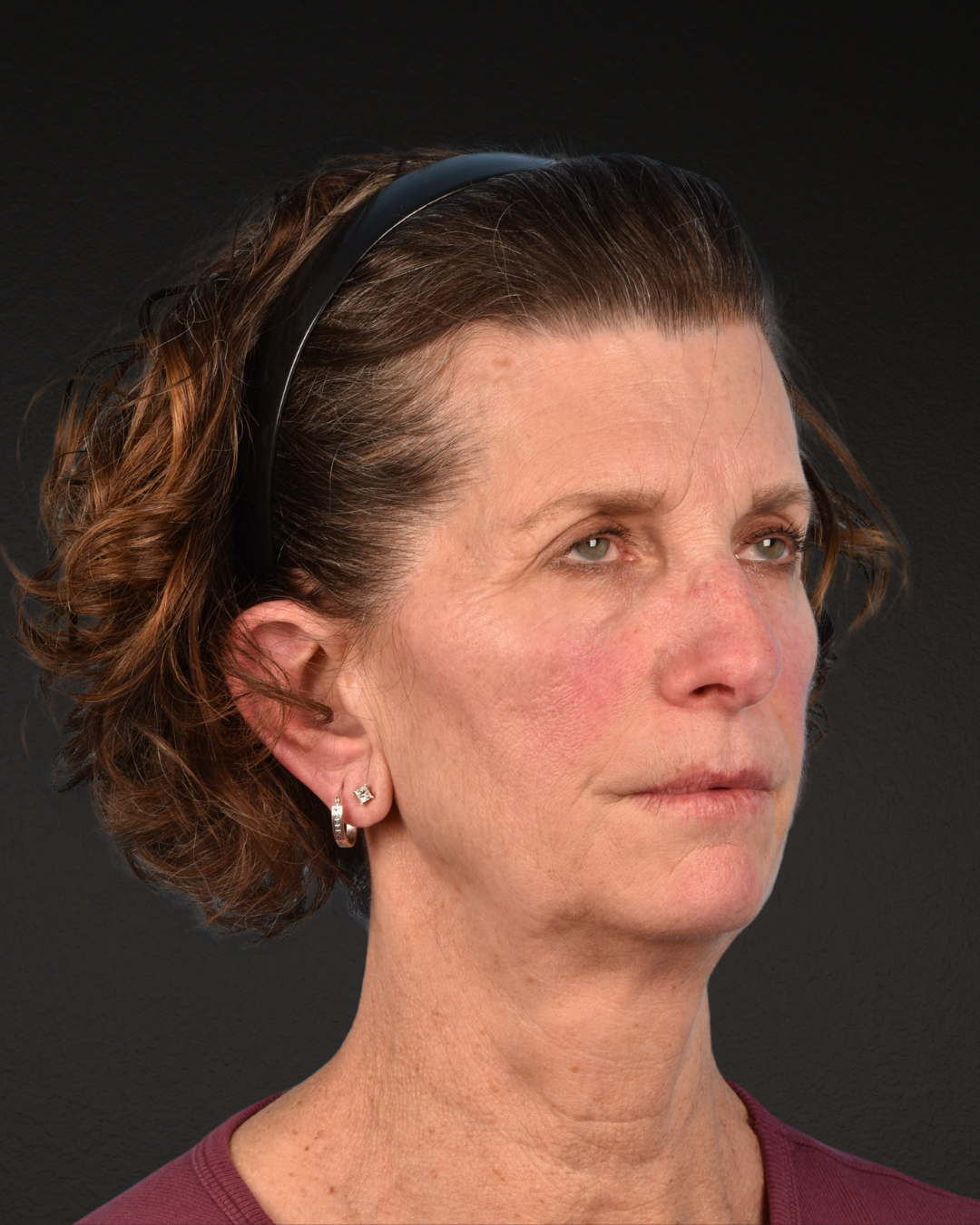 Facelift Before & After Gallery - Patient 307064 - Image 3