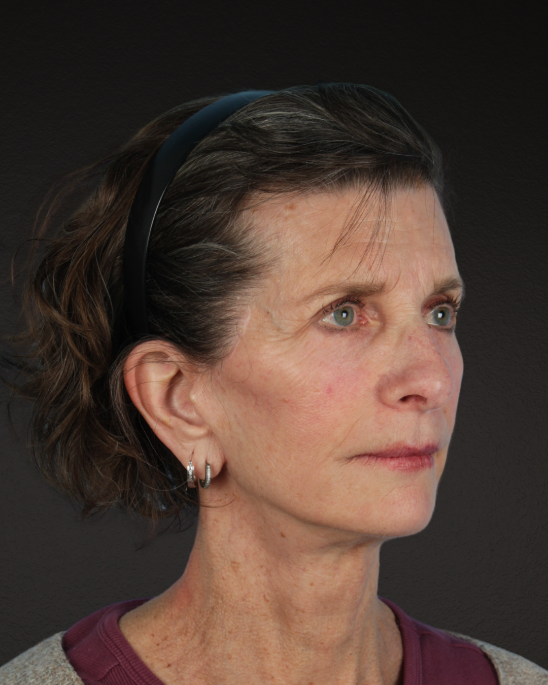 Facelift Before & After Gallery - Patient 307064 - Image 4