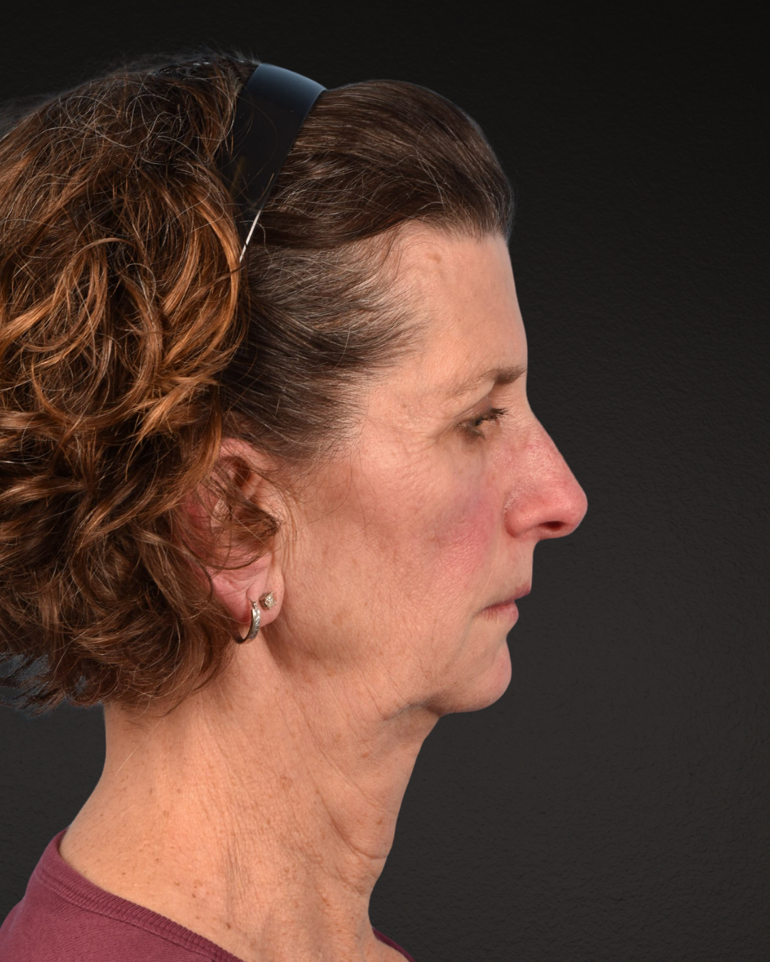Facelift Before & After Gallery - Patient 307064 - Image 5