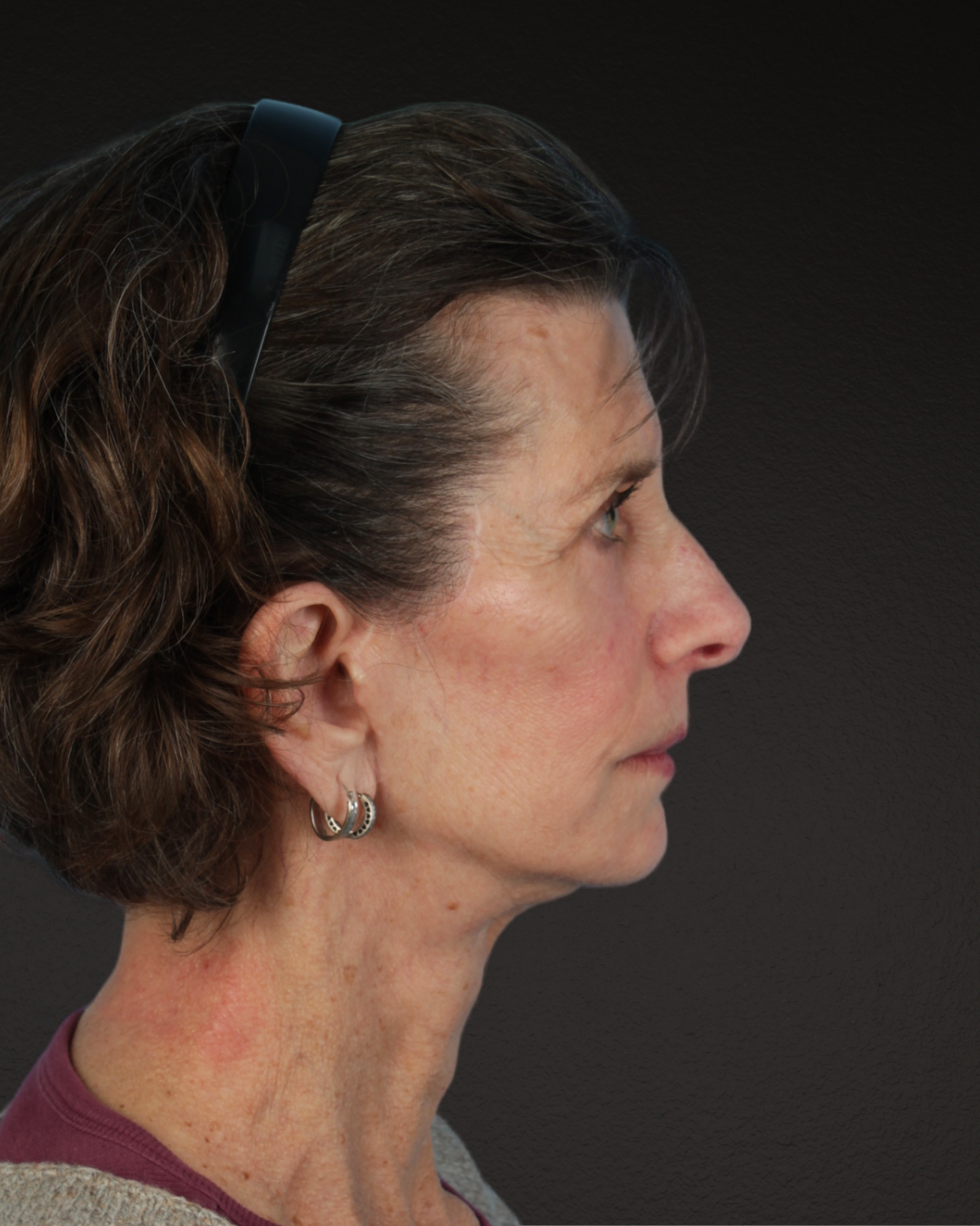 Facelift Before & After Gallery - Patient 307064 - Image 6