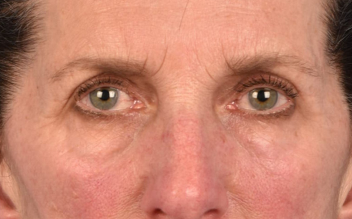Blepharoplasty Before & After Gallery - Patient 364311 - Image 1