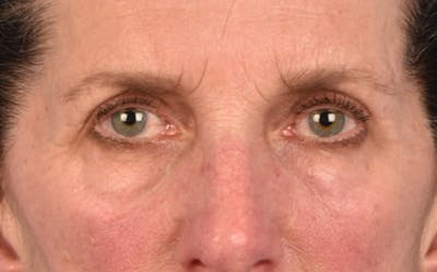 Blepharoplasty Before & After Gallery - Patient 364311 - Image 1