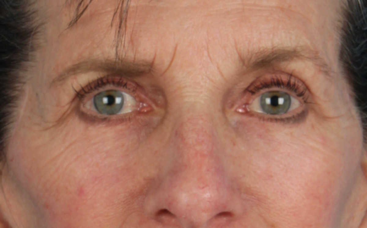 Blepharoplasty Before & After Gallery - Patient 364311 - Image 2