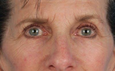 Blepharoplasty Before & After Gallery - Patient 364311 - Image 2