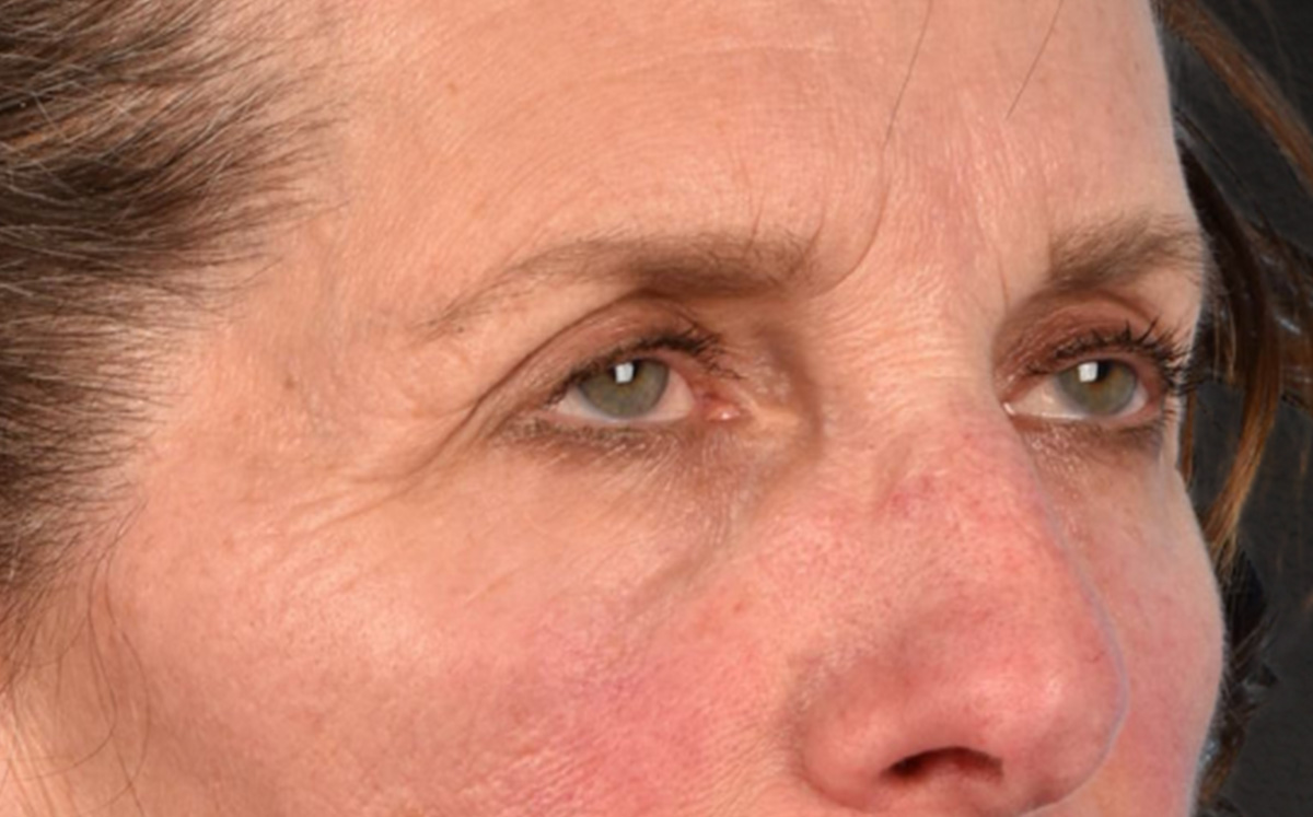 Blepharoplasty Before & After Gallery - Patient 364311 - Image 3