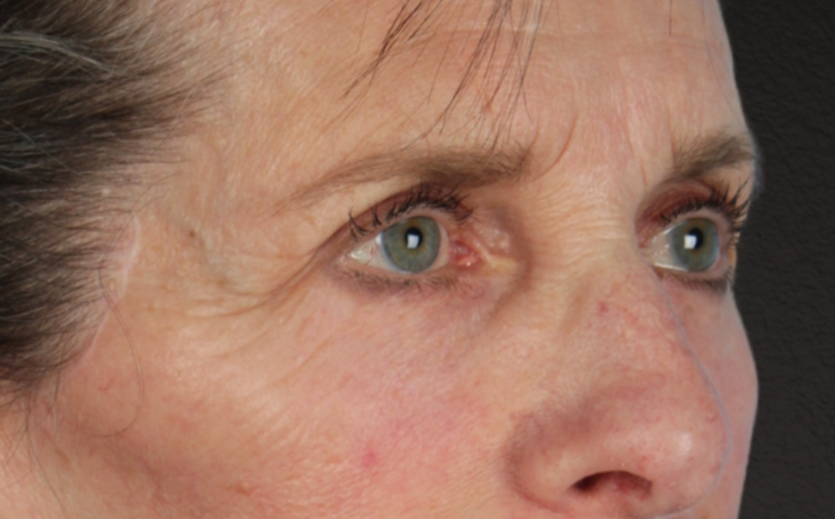 Blepharoplasty Before & After Gallery - Patient 364311 - Image 4