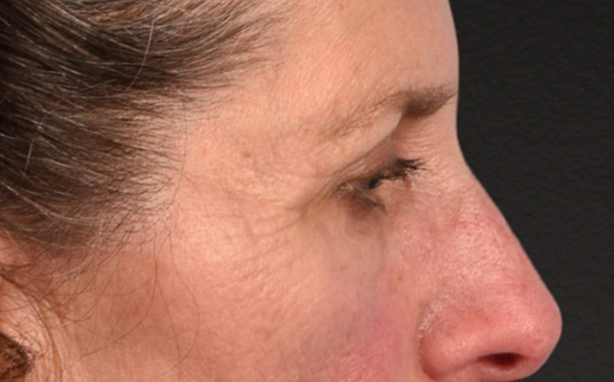 Blepharoplasty Before & After Gallery - Patient 364311 - Image 5