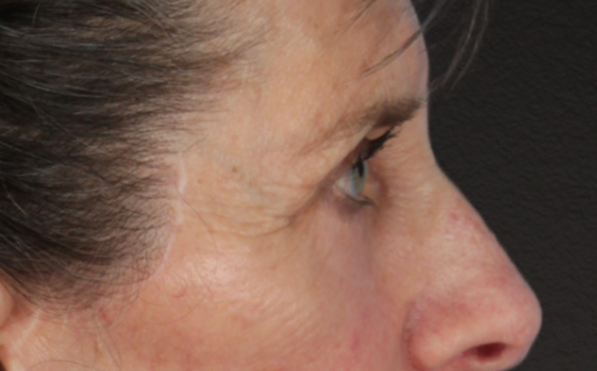 Blepharoplasty Before & After Gallery - Patient 364311 - Image 6