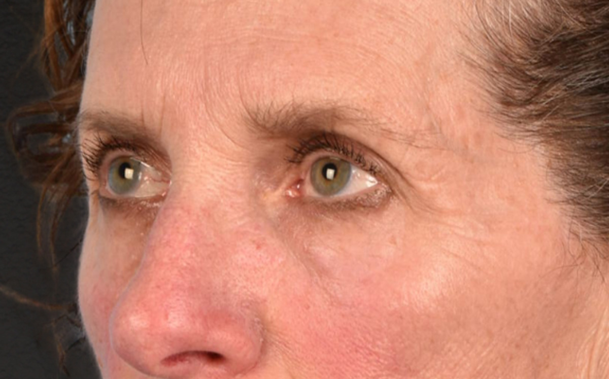 Blepharoplasty Before & After Gallery - Patient 364311 - Image 7