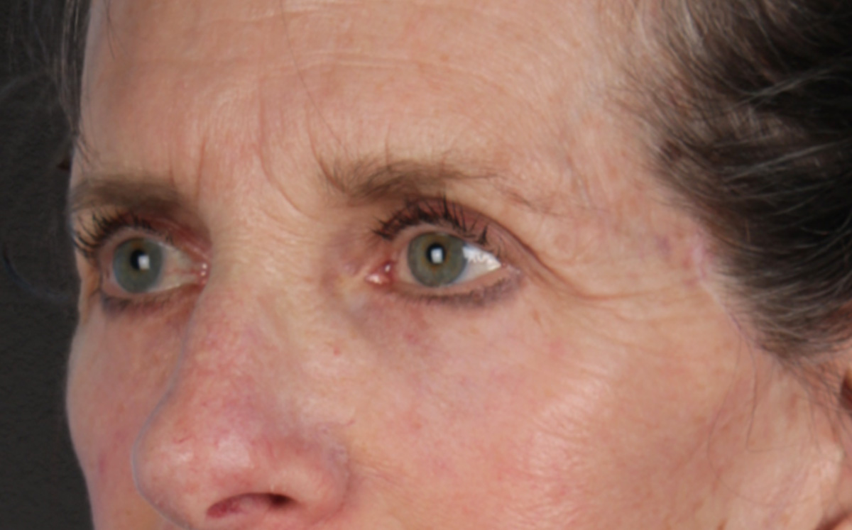 Blepharoplasty Before & After Gallery - Patient 364311 - Image 8
