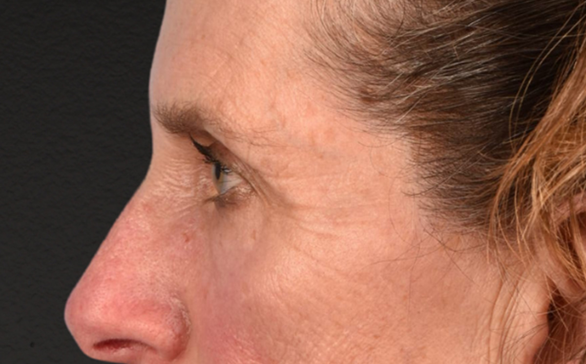 Blepharoplasty Before & After Gallery - Patient 364311 - Image 9