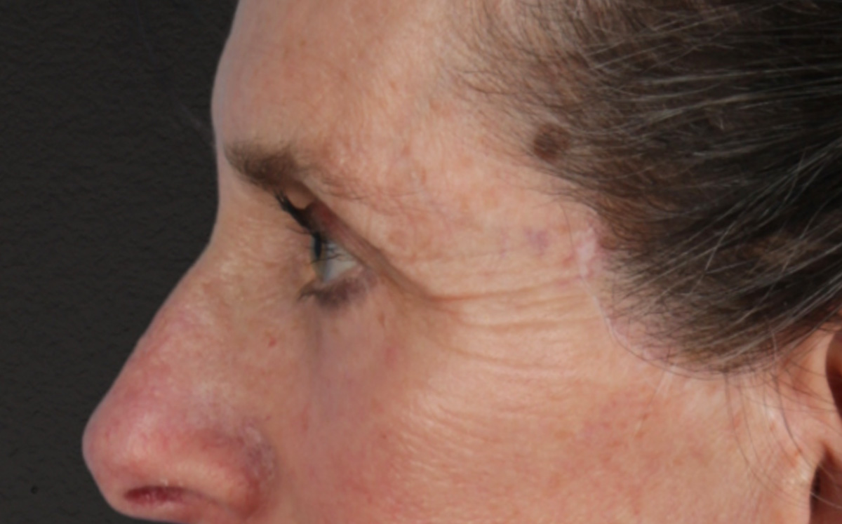Blepharoplasty Before & After Gallery - Patient 364311 - Image 10