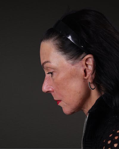 Facelift Before & After Gallery - Patient 199753 - Image 2