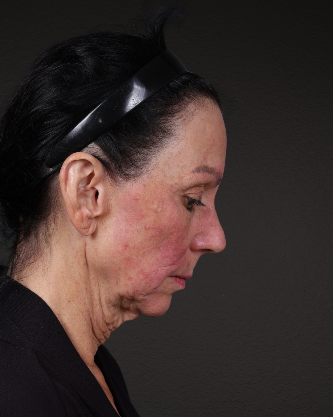 Facelift Before & After Gallery - Patient 199753 - Image 5