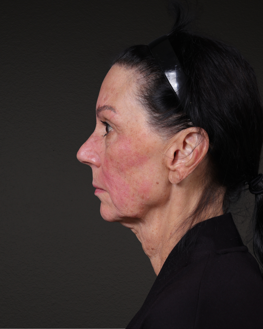 Facelift Before & After Gallery - Patient 199753 - Image 3