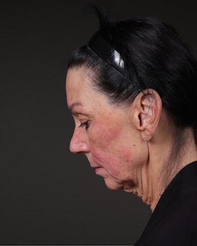 Facelift Before & After Gallery - Patient 199753 - Image 1