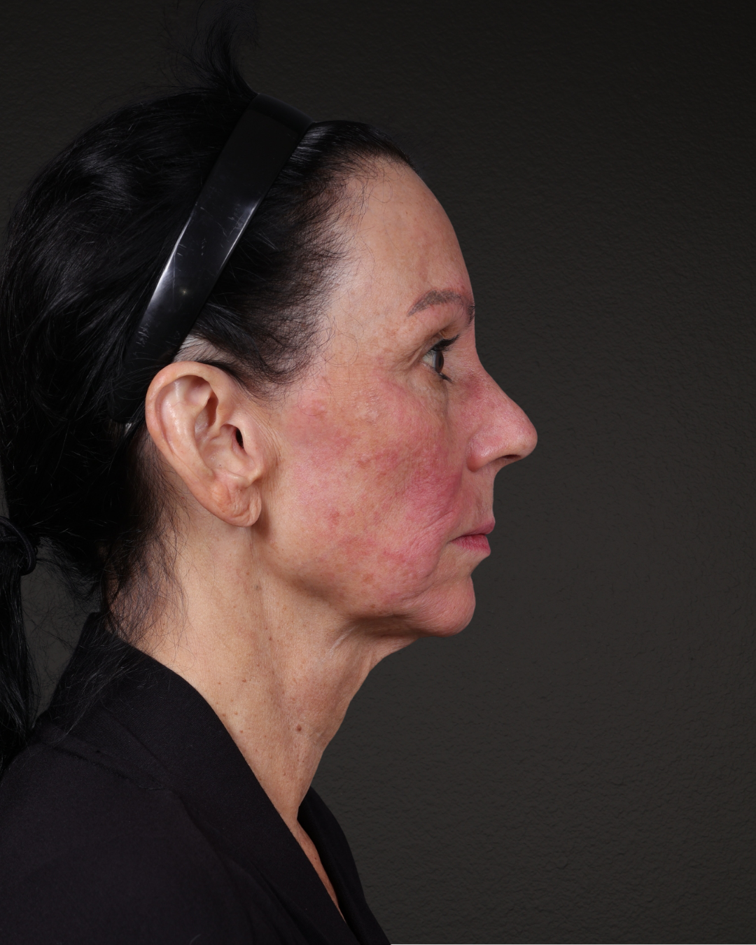 Facelift Before & After Gallery - Patient 199753 - Image 7