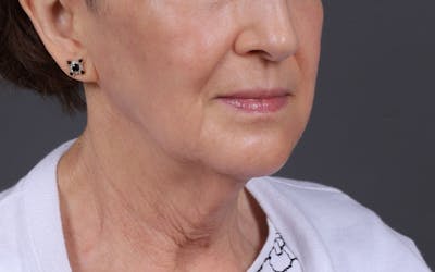 Fat Transfer Before & After Gallery - Patient 180007 - Image 2