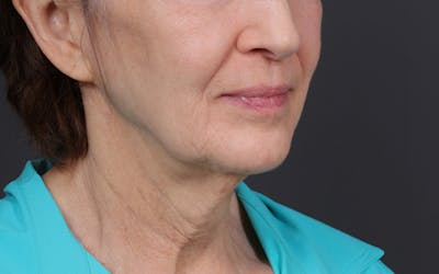 Fat Transfer Before & After Gallery - Patient 180007 - Image 1