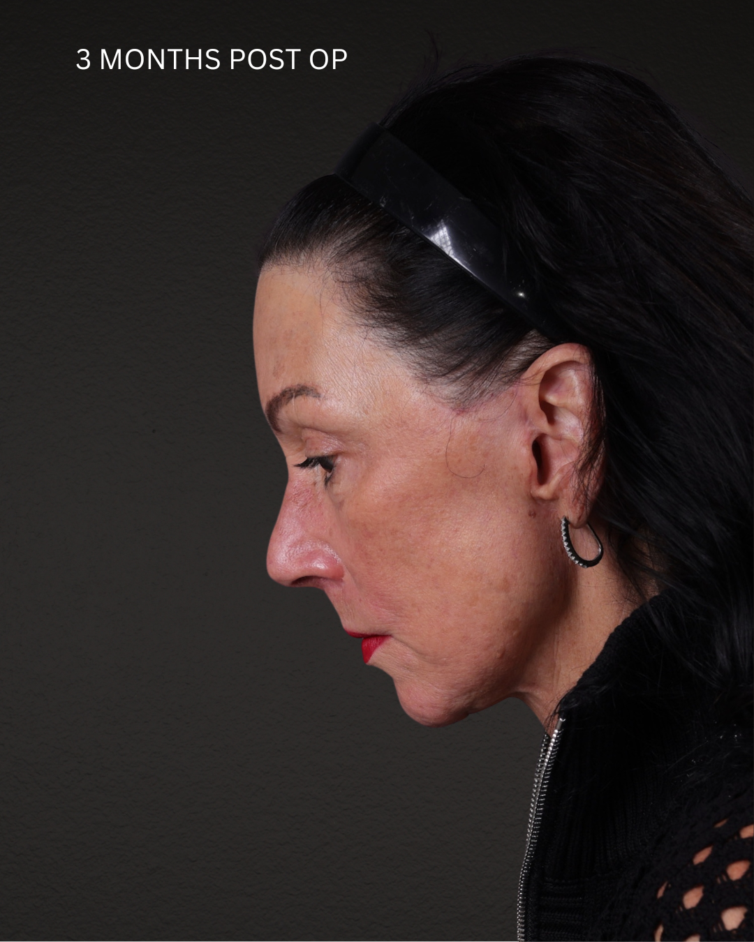 Facelift Before & After Gallery - Patient 199753 - Image 2