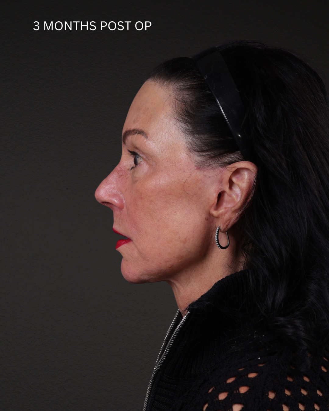 Facelift Before & After Gallery - Patient 199753 - Image 4