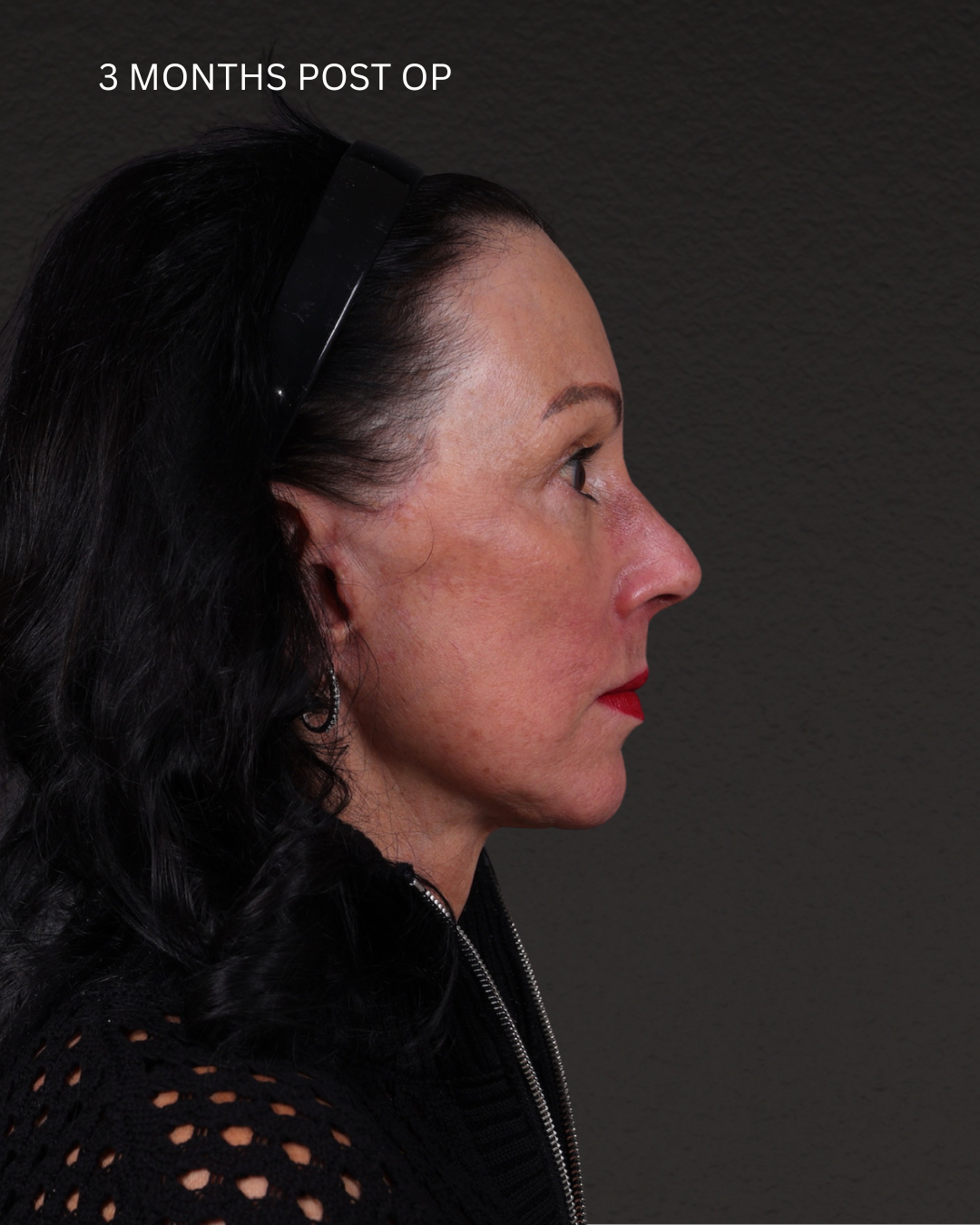 Facelift Before & After Gallery - Patient 199753 - Image 8