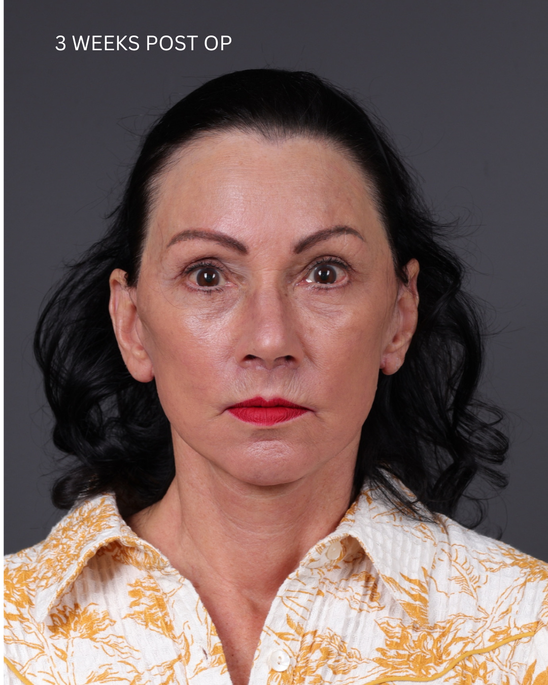 Facelift Before & After Gallery - Patient 199753 - Image 10