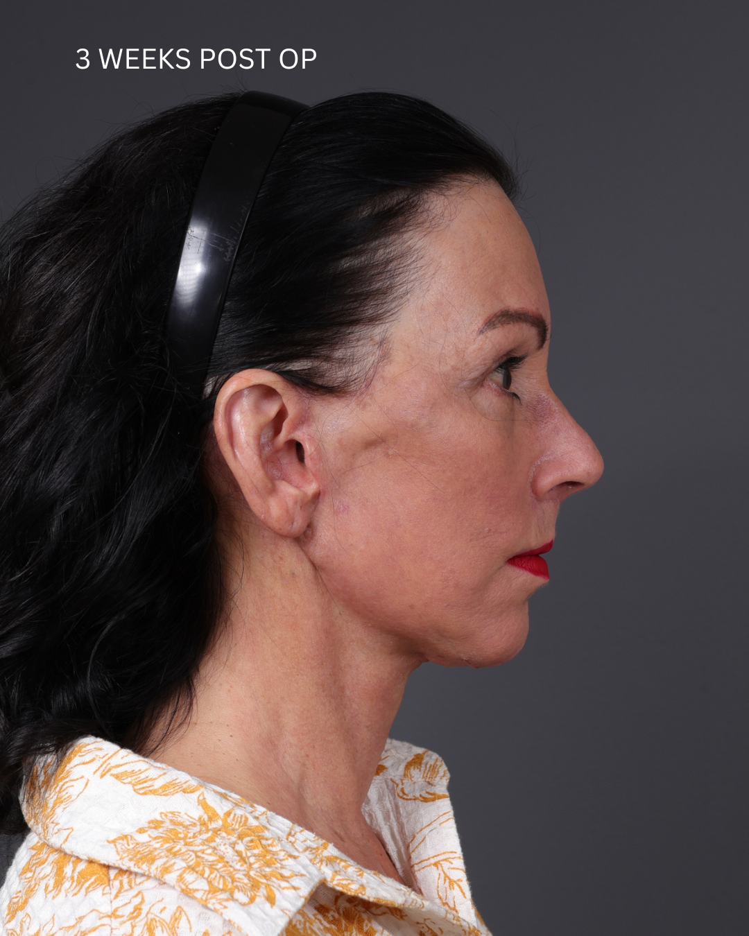 Facelift Before & After Gallery - Patient 199753 - Image 14