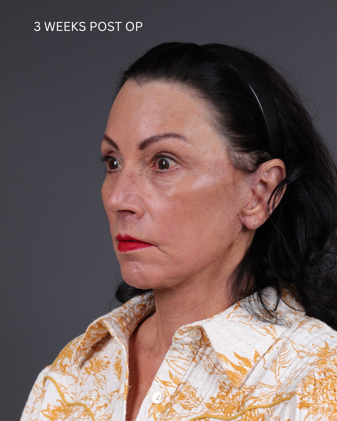 Facelift Before & After Gallery - Patient 199753 - Image 16